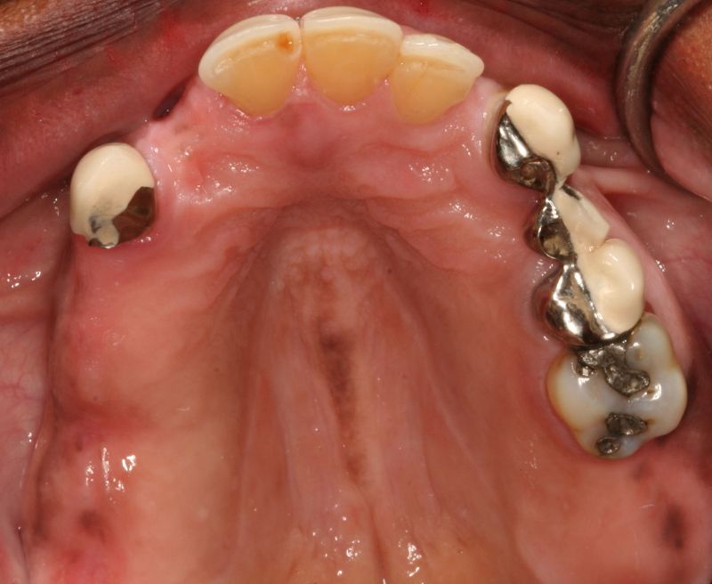 Hall Dentistry Implant Rehabilitation