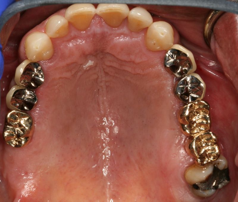 Hall Dentistry Implant Case After