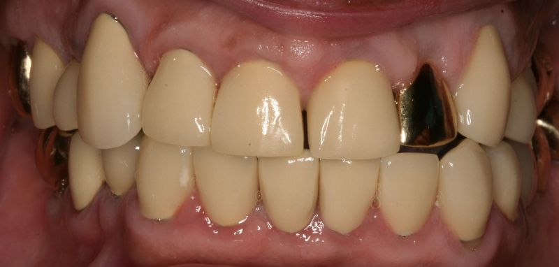 Hall Dentistry Full Mouth rehab after Image
